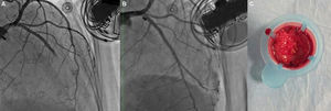 (A) Left coronary angiogram showing a thrombotic total occlusion in the mid segment of the left anterior descending artery (LAD); (B) left coronary angiogram following percutaneous coronary intervention showing no significant stenoses; (C) thrombotic material retrieved from the LAD by thrombus aspiration.