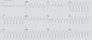 12-lead electrocardiogram revealing ventricular tachycardia, with a rate response of approximately 170 bpm and a pattern of right bundle branch block.