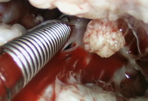 On operative inspection, the lesion was between the anterior mitral leaflet and primary chordae.