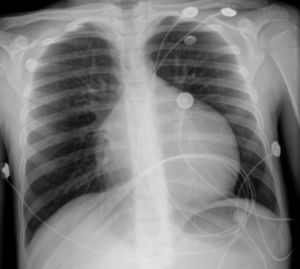 Radiografia do tórax revela aumento do índice cardiotorácico e sinais de congestão vascular pulmonar.
