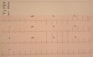 ECG showing 2 mm ST elevation, with Q waves and T-wave inversion, in V1–V2. ST depression can also be observed in the inferolateral leads.