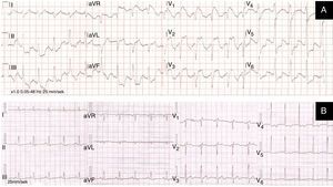 (A) The initial ECG from an ambulance transmitted to the cardiac catheterization laboratory via the LIFENET system showing ST-segment elevation myocardial infarction pattern; (B) ECG on day of discharge.