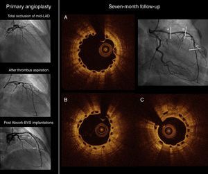 Primary angioplasty and seven-month follow-up coronary angiography and optical coherence tomography cross-sectional views.