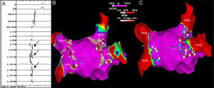 Eletrograma pré‐ablação (A) documentando potencial da veia pulmonar superior direita (setas). Mapa de voltagem antes (B) e depois de ablação (C) visualizado a partir do teto da aurícula esquerda, sendo possível observar os locais de aplicação de radiofrequência (bolas vermelhas e brancas). VPID: veia pulmonar inferior direita; VPIE: veia pulmonar inferior esquerda; VPSD: veia pulmonar superior direita; VPSE: veia pulmonar superior esquerda.