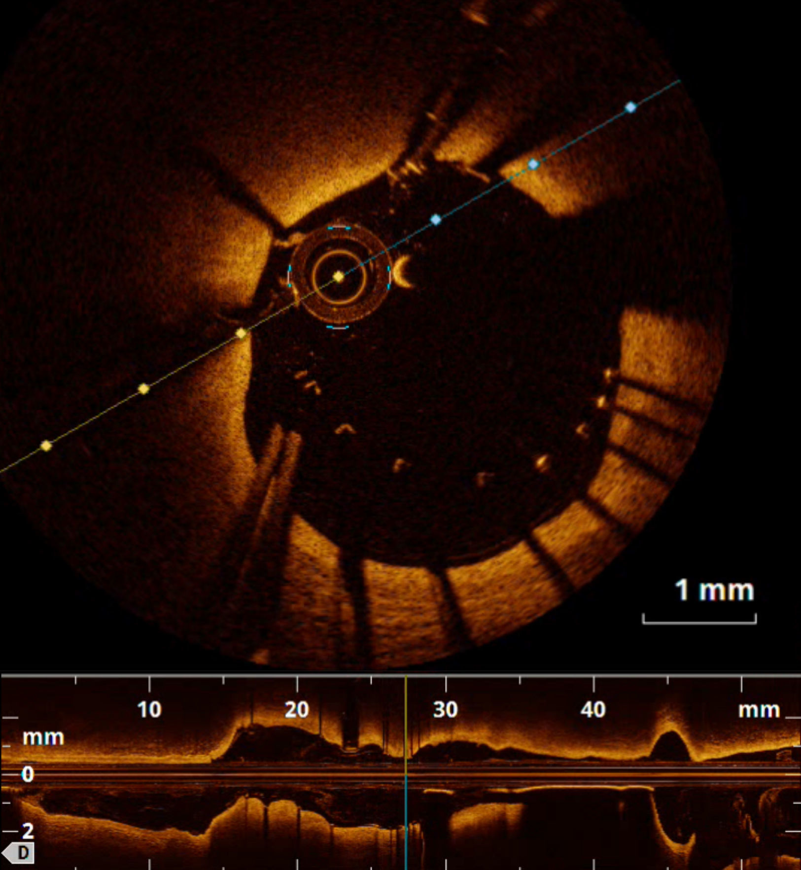 Ccot Radiographic Coronary optical coherence tomography: A practical overview of current ...