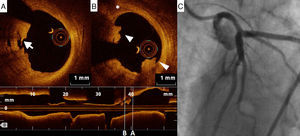 (A) Left main artery lesion: appearance on optical coherence tomography, with ulceration (arrow); (B) thrombus (triangles) and a thin-cap fibroatheroma (asterisk); (C) these findings were undetected by invasive coronary angiography.