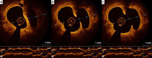 (A–C) Optical coherence tomography showing a large spontaneous ulceration in the circumflex artery.