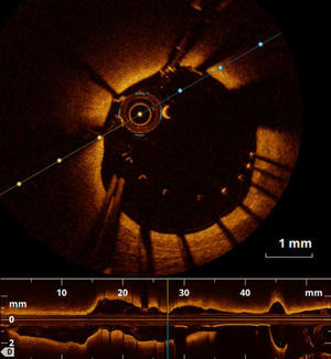 Optical coherence tomography revealing stent malapposition with a large distance between struts and vessel wall.