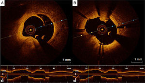(A) Edge dissection, and (B) small thrombus following stent placement, detected by optical coherence tomography.