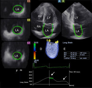The three-dimensional echocardiographic dataset is displayed in apical 4-chamber (A) and 2-chamber views (B) and three short-axis views in the basal (C3), mid-atrial (C5), and superior (C7) regions, respectively. Three-dimensional LA cast (D), LA volumetric data, ejection fraction (EF) (E) and global peak longitudinal strain (white arrow) and global longitudinal strain at atrial contraction (dashed arrow) (F) are also presented. LA: left atrium; LV: left ventricle; RA: right atrium; RV: right ventricle.