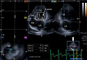 From the three-dimensional echocardiographic dataset, the mitral annulus (MA) can be obtained by optimizing cross-sectional planes in apical 4-chamber (A) and 2-chamber (B) views, demonstrating an optimal MA image on cross-sectional view (C7). Using Doppler-derived mitral inflow peak A wave velocity, the left atrial ejection force (LAEF) can be calculated. E and A: Doppler-derived mitral inflow velocities; LA: left atrium; LV: left ventricle; MA: mitral annulus; RA: right atrium; RV: right ventricle.