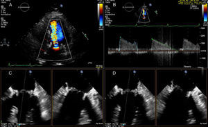 Transthoracic echocardiography demonstrating increased flow velocity across the mitral bioprosthesis (A), with prolongation of pressure half-time and elevated mean pressure gradient (B); two-dimensional transesophageal echocardiography showing marked thickening of two of the three mitral leaflets (C systolic frame, D diastolic frame).
