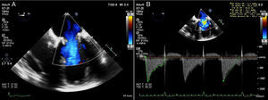 Follow-up two-dimensional transesophageal echocardiography showing normal flow velocity (A) and mean pressure gradient (B) across the mitral bioprosthesis.
