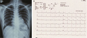 (A) Chest radiograph in posteroanterior view showing large calcified left ventricular apical aneurysm (*) and basal aneurysm (**); (B) electrocardiogram showing no pathological Q waves and normal progression of precordial R wave.