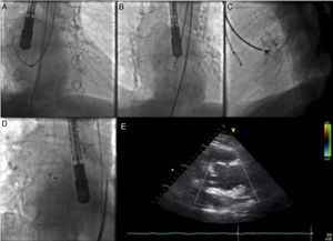 Images illustrating percutaneous closure of aortic pseudoaneurysm. (A) Left internal mammary diagnostic catheter inside the delivery sheath engaging the pseudoaneurysm cavity; (B) Amplatzer atrial septal defect (ASD) occluder with the distal disk opened inside the pseudoaneurysm cavity, and the proximal disk misshapen inside the aortic lumen; (C) Amplatzer ASD device deployed across the aortic wall defect; (D) Amplatzer ASD device released in a stable position; (E) transthoracic echocardiography showing position of the device without interfering with the bioprosthesis.