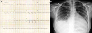 Eletrocardiograma de 12 derivações (A) e radiografia de tórax em sentido anteroposterior (B).