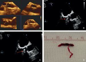 An 85-year-old woman with a history of severe aortic stenosis who was accepted for transfemoral valve replacement. After the valve was crossed with the hydrophilic wire, a mobile echogenic image (MEI) was observed by the TEE operator and identified as thrombus. 2000 U of heparin were administered, but unfortunately the thrombus embolized. Cerebral angiography was then performed and showed occlusion of the right mid cerebral artery, and thrombectomy was successfully performed. The patient was discharged without neurological deficit. (A) Three-dimensional determination of aortic valvular area (0.6 cm2); (B and C) mobile echogenic image observed during the procedure and identified as thrombus; (D) macroscopic image of the thrombus that was extracted from the right mid cerebral artery.