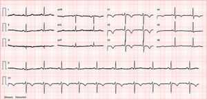 ECG of a young female with right ventricular arrhythmogenic dysplasia showing T-wave inversion, without ST-segment elevation, in V1–V4.
