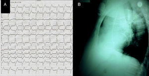 (A) Right bundle branch block pattern of the paced rhythm electrocardiogram; (B) lateral chest radiograph showing posterior orientation of the pacing lead.