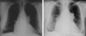 Chest radiographs from 1992 (left) and 2011 (right) showing mediastinal enlargement.
