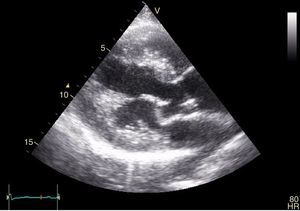 Transthoracic echocardiogram, long-axis parasternal view, showing the mitral valve anterior leaflet aneurysm.