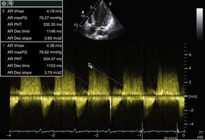 Continuous wave spectral Doppler recording through the aortic valve. Pressure half time is noted to be 334 ms.