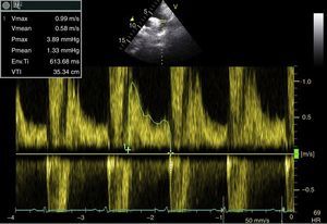 Holodiastolic flow reversal in the descending thoracic aorta indicative of significant aortic valve regurgitation.