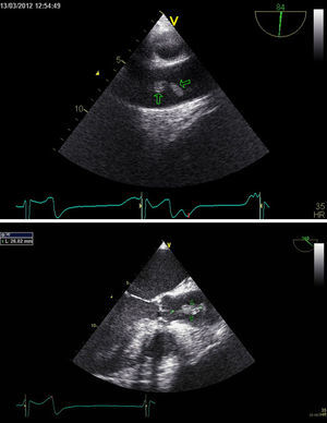 Transesophageal echocardiogram showing a 14 mm pedunculated and highly mobile mass attached to the intima, at the level of the sinotubular junction.