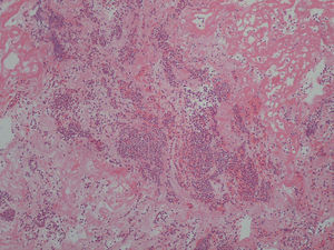 Histopathological study showing granulocyte infiltration.