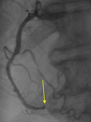 Distal occlusion of the right coronary artery (arrow).