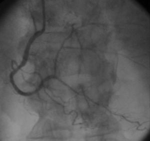 Successful primary angioplasty of the right coronary artery.