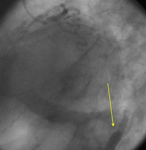 Contrast retention image on coronary angiography (arrow).