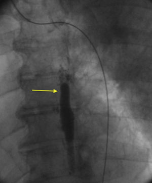 Coronary angiography, anteroposterior projection, showing the contrast retention image in the midline (arrow).