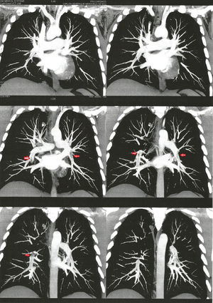 Mostra sinais radiológicos de embolia pulmonar pela angiotomografia (setas).