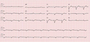 ECG: RS, 67/min, bloqueio auriculoventricular do 1.° grau, baixa voltagem nas derivações frontais e bloqueio completo de ramo esquerdo.