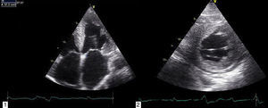 Ecocardiograma transtorácico: ventrículo esquerdo não dilatado com hipertrofia severa do septo e moderada das restantes paredes, ventrículo direito não dilatado, dilatação biauricular severa (1); derrame pericárdico circunferencial de grau ligeiro (2).