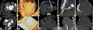 Use of computed tomography in pericardiocentesis. (a) Characterization and assessment of effusion; (b) determination of best entry point and needle orientation; (c) control of needle progression and relation with surrounding structures; (d) pigtail positioning; (e) final result and control of evolution.