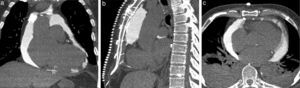 Example of a case in which intrapericardial contrast was used. (a) Coronal view; (b) sagittal view; (c) axial view.