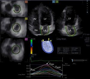 Images from three-dimensional full-volume dataset showing left atrium: apical 4-chamber (A) and 2-chamber views (B) and short-axis views at basal (C3), mid- (C5) and superior (C7) left atrial level are demonstrated together with left atrial volumetric data and a three-dimensional cast of the left atrium. Time-segmental strain curves of all 16 left atrial segments and global left atrial volume changes throughout the cardiac cycle are also presented. White arrow: peak strain. LA: left atrium; LV: left ventricle; RA: right atrium; RV: right ventricle; Vmax, Vmin and VpreA: maximum and minimum left atrial volumes and left atrial volume before atrial contraction, respectively.