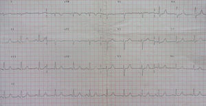 Normal ECG.