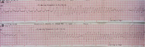 Polymorphic ventricular tachycardia (PVT) triggered by ventricular pacing (A); short-coupled (290 ms) PVT (B).