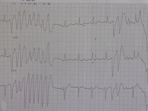 Short-coupled interval (280 ms) nonsustained polymorphic ventricular tachycardia.