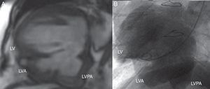 (A) Magnetic resonance images showing the presence of three ventricular cavities; (B) left ventriculography showing large bilobulated aneurysm in the inferior wall of the left ventricle. LV: left ventricle; LVA: left ventricular aneurysm; LVPA: left ventricular pseudoaneurysm.