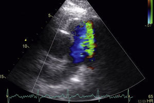 Transthoracic echocardiogram (parasternal short-axis view): color Doppler displays a continuous turbulent flow from the aorta to the left branch of the pulmonary artery, consistent with a patent ductus arteriosus.