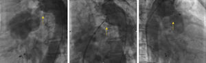 Fluoroscopy during percutaneous patent ductus arteriosus closure: left, a continuous flow can be seen from the aorta to the pulmonary artery (yellow arrow); center, during device placement (yellow arrow); right, after the procedure the device is properly positioned with no residual shunt (yellow arrow).