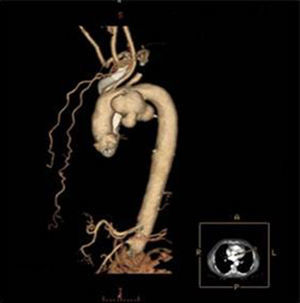 Contrast-enhanced thoracic computed tomography with sagittal reconstruction, showing a saccular aneurysm of the aortic arch.