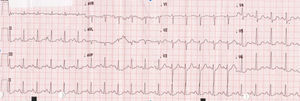 Eletrocardiograma: taquicardia sinusal, infradesnivelamento ST em V4 e V5.
