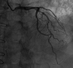 Coronary angiography: images of the left coronary artery showing two mid left anterior descending artery intermediate stenoses (50-70%).