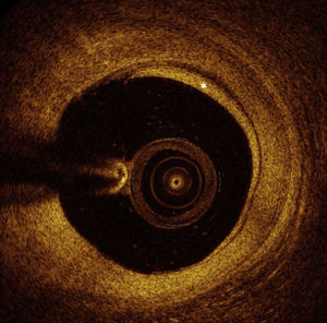 Optical coherence tomography: image of the mid left anterior descending artery with lipid-rich atherosclerotic plaque (asterisk: incomplete blood displacement).
