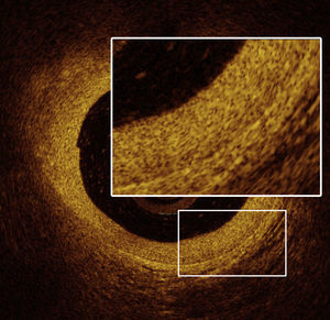 Optical coherence tomography: image of the proximal left anterior descending artery revealing intimal hyperplasia with maximal thickness of 0.36 mm.